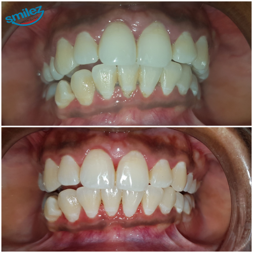Scaling & Cleaning Of Teeth, Gum Surgeries, Ahmedabad Dentists