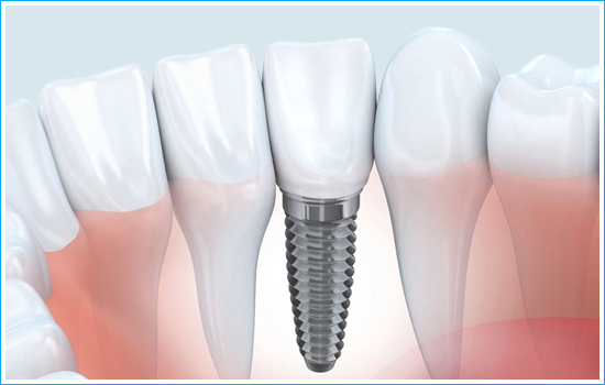 Dental Implants in Ahmedabad, Smilez Dental Clinic