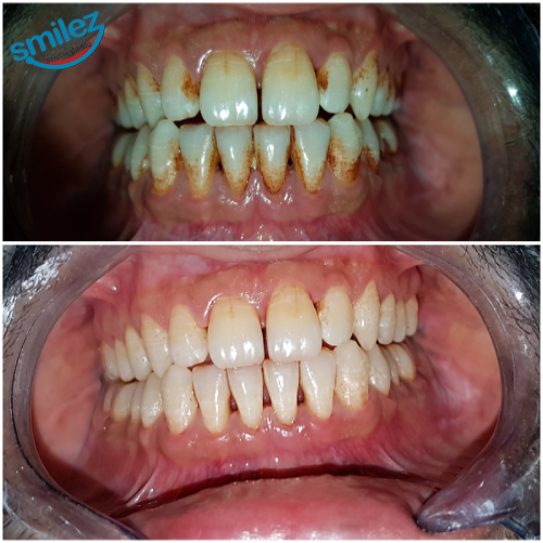 Scaling & Cleaning Of Teeth, Gum Surgeries, Ahmedabad Dentists