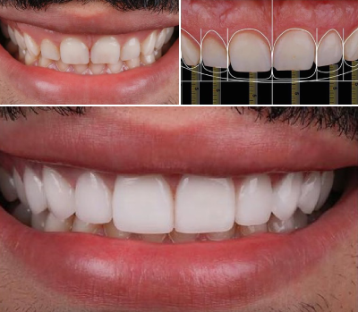 Smile Makeover, cosmetic dentistry dentist in ahmedabad, Dental Clini