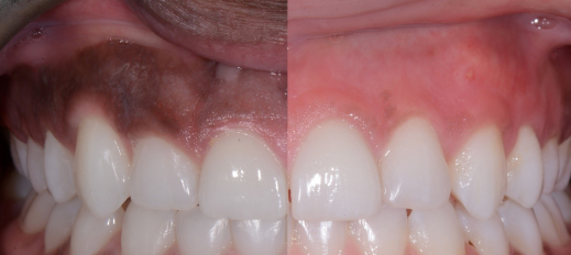 Cosmetic dentistry Ahmedabad, Gum recontouring and depigmentation, Bonding, Tooth Jewellery, Teeth Whitening