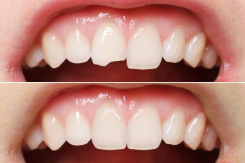 Cosmetic dentistry Ahmedabad, Gum recontouring and depigmentation, Bonding, Tooth Jewellery, Teeth Whitening