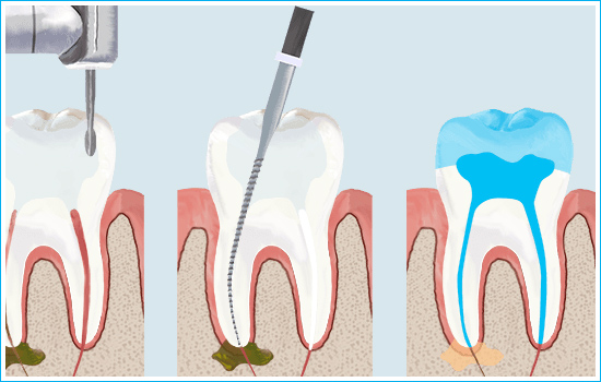 Root Canal Treatement in Ahmedabad, Smilez Dental Clinic