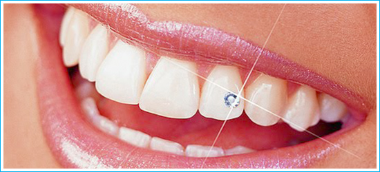 Cosmetic dentistry Ahmedabad, Gum recontouring and depigmentation, Bonding, Tooth Jewellery, Teeth Whitening