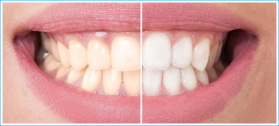 Cosmetic dentistry Ahmedabad, Gum recontouring and depigmentation, Bonding, Tooth Jewellery, Teeth Whitening